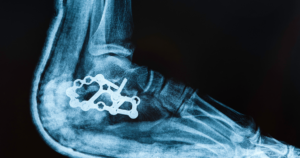 When to suspect an Ankle Fracture?